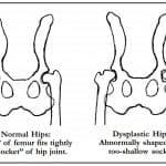 Hip Dysplasia