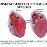 Aortic Stenosis